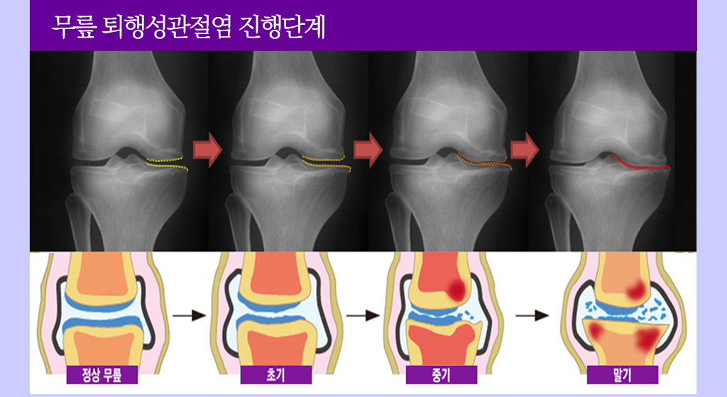 무릎 퇴행성관절염 진행단계