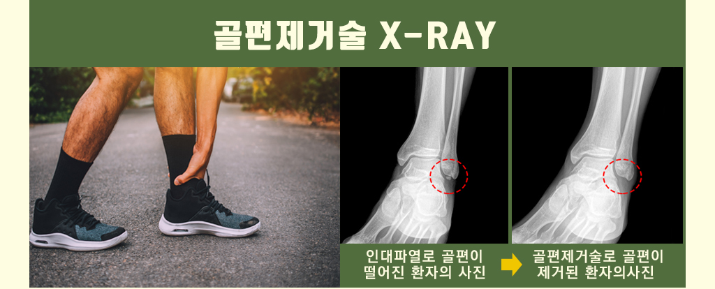골편제거술 X-RAY : 인대파열로 골편이 떨어진 환자의 사진 → 골편제거술로 골편이 제거된 환자의사진 