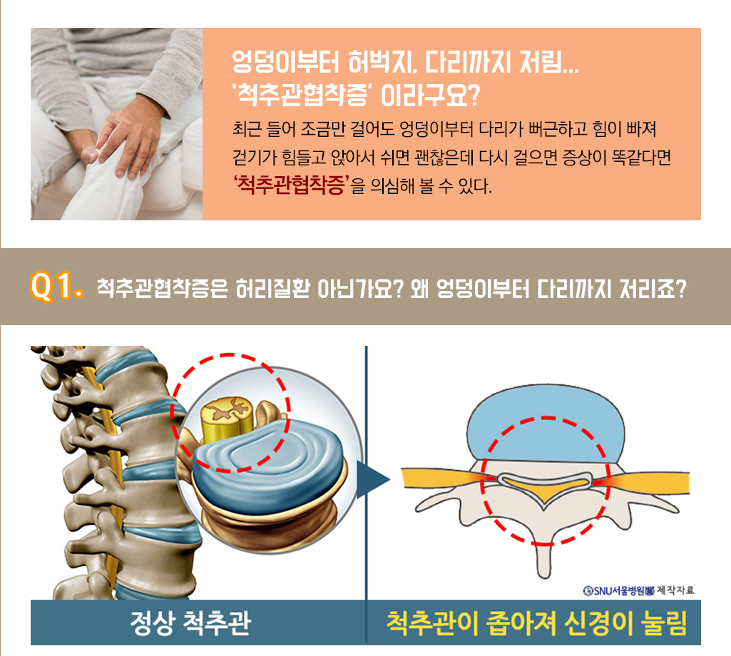 엉덩이부터 허벅지, 다리까지 저림... ‘척추관협착증’ 이라구요?
			최근 들어 조금만 걸어도 엉덩이부터 다리가 뻐근하고 힘이 빠져 걷기가 힘들고 앉아서 쉬면 괜찮은데 다시 걸으면 증상이 똑같다면 ‘척추관협착증’을 의심해 볼 수 있다. 
			Q1. 척추관협착증은 허리질환 아닌가요? 왜 엉덩이부터 다리까지 저리죠?
			정상 척추관 척추관이 좁아져 신경이 눌림