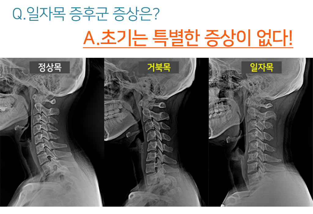 Q.일자목 증후군 증상은? A.초기는 특별한 증상이 없다!