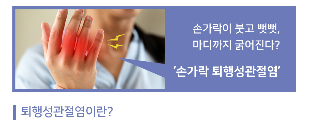 손가락이 붓고 뻣뻣, 마디까지 굵어진다? ‘손가락 퇴행성관절염’  퇴행성관절염이란?
