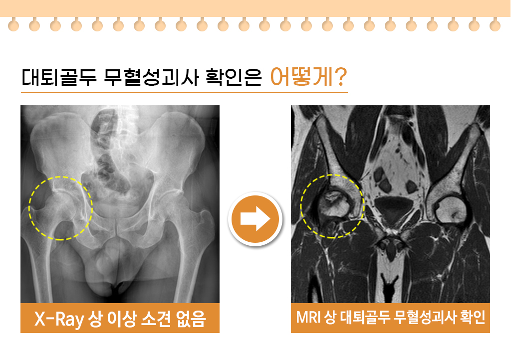 대퇴골두 무혈성괴사 확인은 어떻게?, X-Ray와 MRI사진