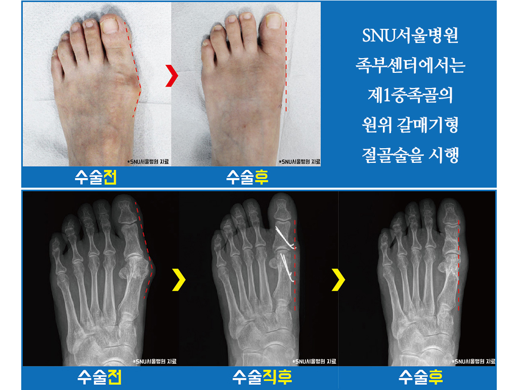 SNU서울병원 족부센터에서는 제1중족골의 원위 갈매기형 절골술을 시행
