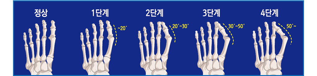 정상, 1단계 ~20도, 2단계 20~30도, 3단계 30~50도, 4단계 50~도, 