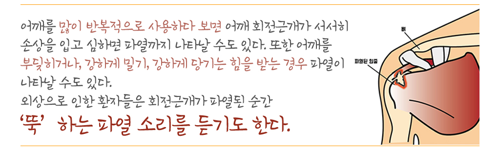 어깨를 많이 반복적으로 사용하다 보면 어깨 회전근개가 서서히 손상을 입고 심하면 파열까지 나타날 수도 있다. 또한 어깨를 부딪히거나, 강하게 밀기, 강하게 당기는 힘을 받는 경우 파열이 나타날 수도 있다. 외상으로 인한 환자들은 회전근개가 파열된 순간 ‘뚝’하는 파열 소리를 듣기도 한다.