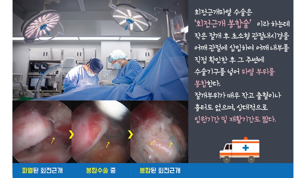 회전근개파열 수술은 ‘회전근개 봉합술’이라 하는데 작은 절개 후 초소형 관절내시경을 어깨 관절에 삽입하여 어깨 내부를 직접 확인한 후 그 주변에 수술기구를 넣어 파열 부위를 봉합한다. 절개부위가 매우 작고 출혈이나 흉터도 없으며, 상대적으로 입원기간 및 재활기간도 짧다.