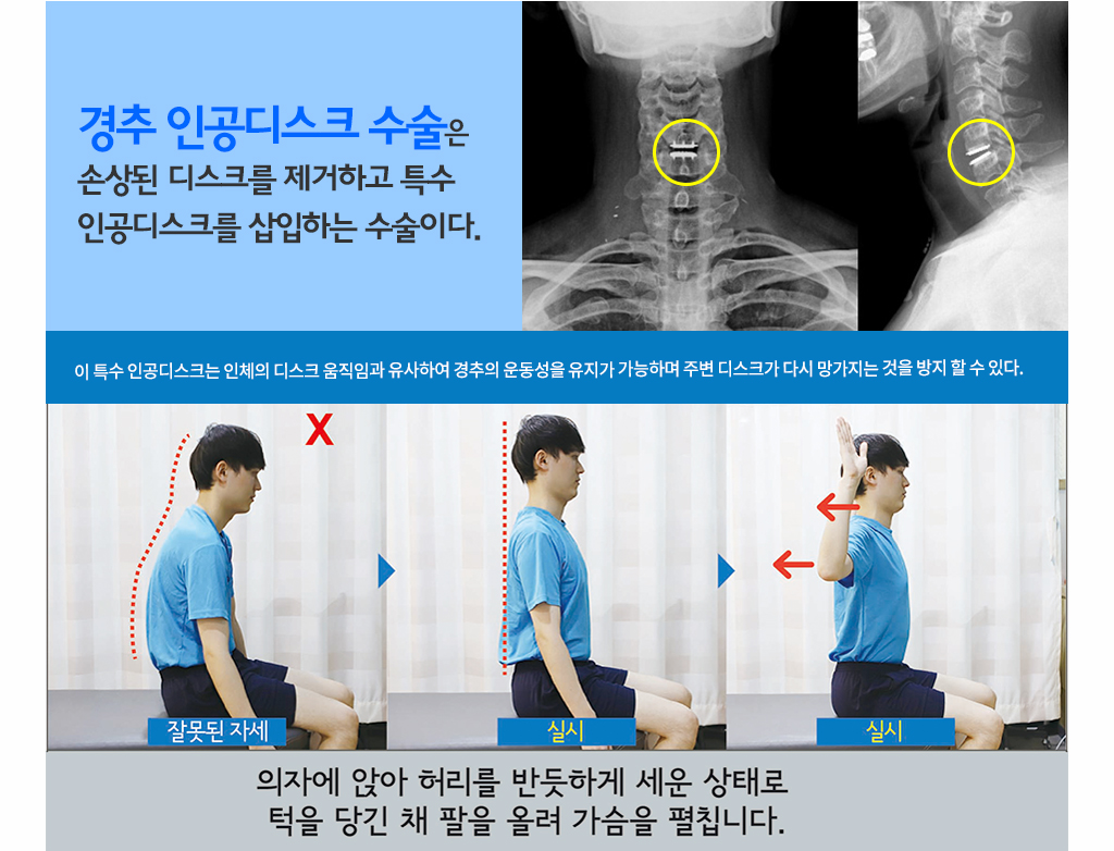 경추 인공디스크 수술은 손상된 디스크를 제거하고 특수 인공디스크를 삽입하는 수술이다. 
			이 특수 인공디스크는 인체의 디스크 움직임과 유사하여 경추의 운동성을 유지가 가능하며 주변 디스크가 다시 망가지는 것을 방지 할 수 있다.
			의자에 앉아 허리를 반듯하게 세운 상태로 턱을 당긴 채 팔을 올려 가슴을 펼칩니다.