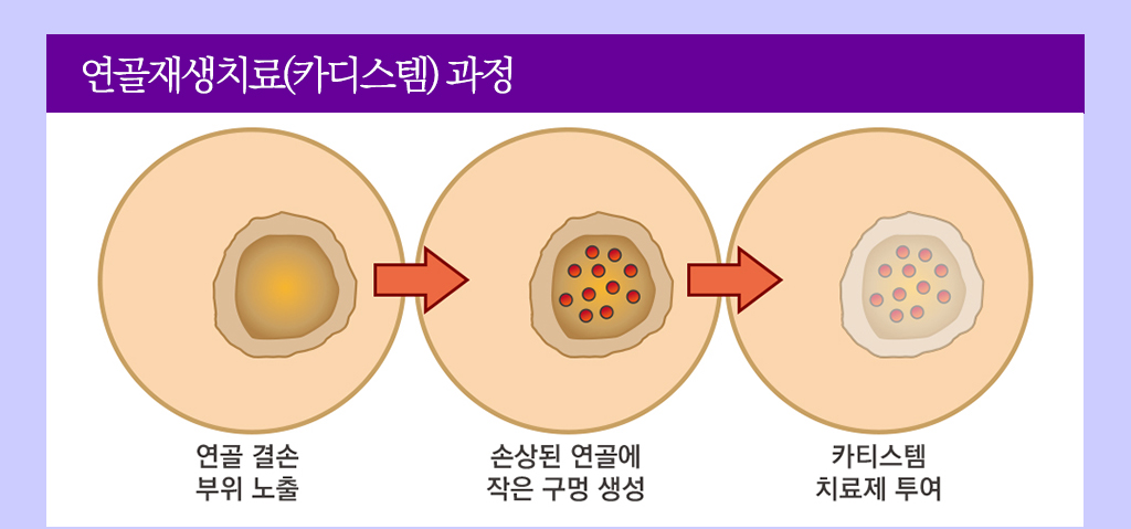 연골재생치료(카디스템) 과정