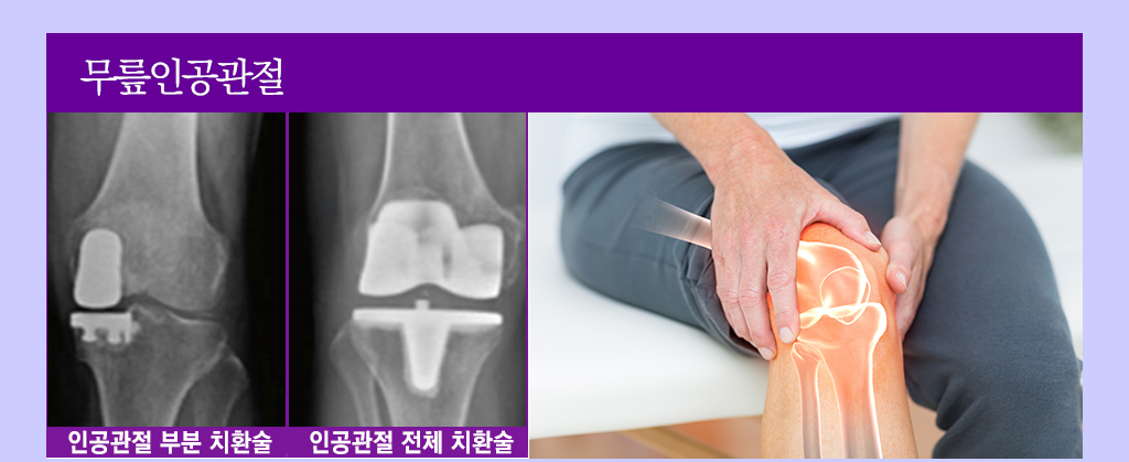 무릎인공관절