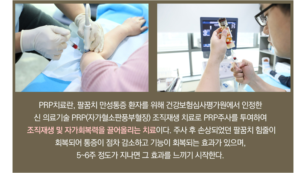 PRP치료란, 팔꿈치 만성통증 환자를 위해 건강보험심사평가원에서 인정한 신 의료기술 PRP(자가혈소판풍부혈장) 조직재생 치료로 PRP주사를 투여하여 조직재생 및 자가회복력을 끌어올리는 치료이다. 주사 후 손상되었던 팔꿈치 힘줄이 회복되어 통증이 점차 감소하고 기능이 회복되는 효과가 있으며, 5~6주 정도가 지나면 그 효과를 느끼기 시작한다. 