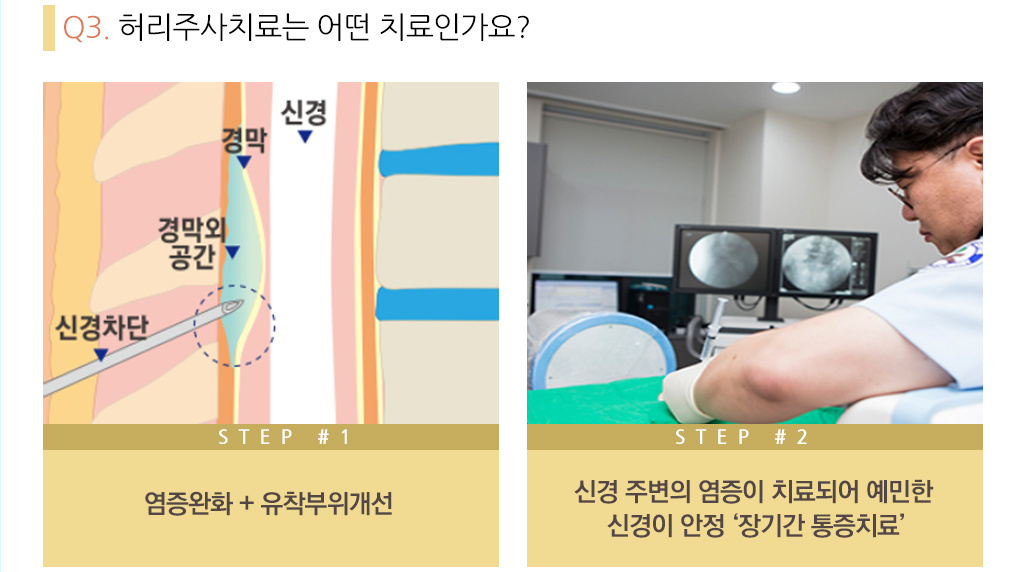 Q2. 허리주사치료는 어떤 치료인가요? step#1-염증완화+유착부위개선, step#2-신경 주변의 염증이 치료되어 예민한 신경이 안정 ‘장기간 통증치료’