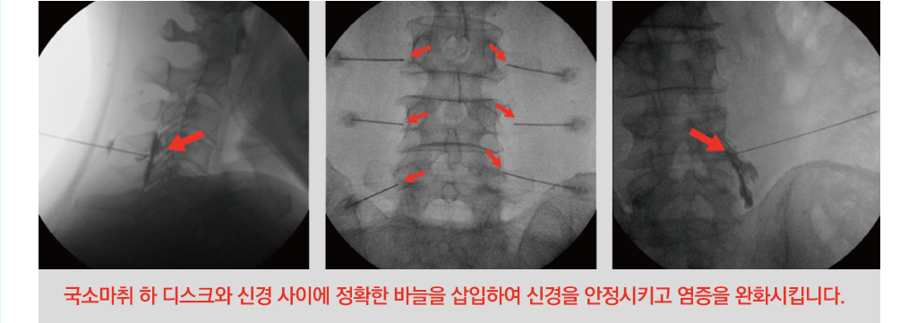 국소마취 하 디스크와 신경 사이에 정확한 바늘을 삽입하여 신경을 안정시키고 염증을 완화시킵니다.