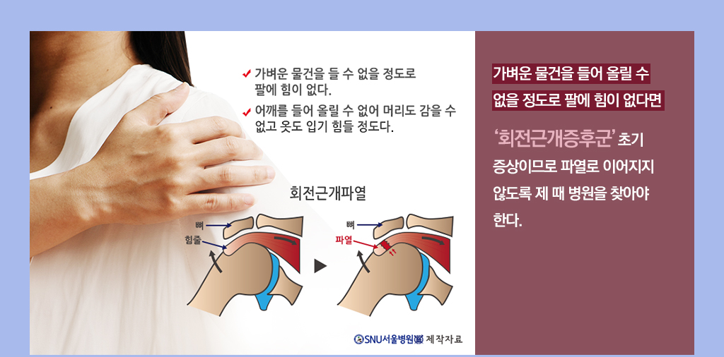 가벼운 물건을 들어 올릴 수 없을 정도로 팔에 힘이 없다면 회전근개증후군 초기 증상이므로 파열로 이어지지 않도록 제 때 병원을 찾아야 한다.