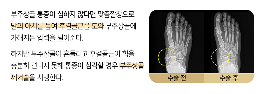 부주상골 통증이 심하지 않다면 맞춤깔창으로 발의 아치를 높여 후결골근을 도와 부주상골에 가해지는 압력을 덜어준다. 하지만 부주상골이 흔들리고 후결골근이 힘을 충분히 견디지 못해 통증이 심각할 경우 부주상골 제거술을 시행한다. 단, 부주상골의 모양이 크면 후결골근을 당기어 주상골에 부착하기 어려운 수술이므로 숙련된 족부 전문 의료진의 기술이 요구된다.