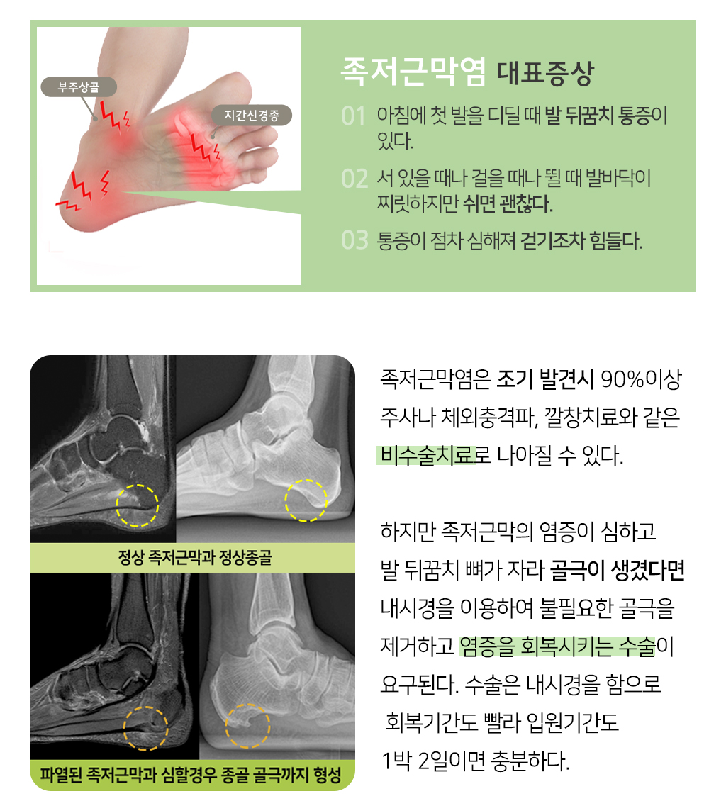 족저근막염 대표증상 1.아침에 첫 발을 디딜 때 발 뒤꿈치 통증이 있다. 2.서 있을 때, 걸을 때, 뛸 때 발바닥이 찌릿하지만 쉬면 괜찮다. 3.통증이 점차 심해져 걷기조차 힘들다. 족저근막염은 조기 발견시 90%이상 주사나 체외충격파, 깔창치료와 같은 비수술치료로 나아질 수 있다. 하지만 족저근막의 염증이 심하고 발 뒤꿈치 뼈가 자라 골극이 생겼다면 내시경을 이용하여 불필요한 골극을 제거하고 염증을 회복시키는 수술이 요구된다. 수술은 내시경하 하므로 회복기간도 빨라 입원기간도 1박 2일이면 충분하다.
