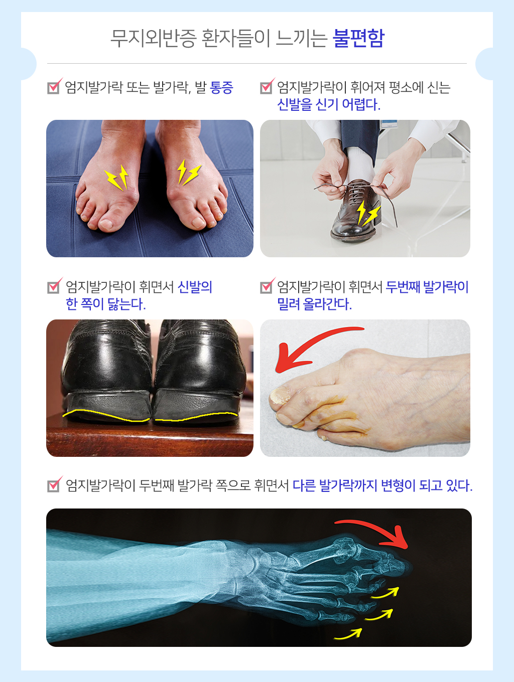 무지외반증 환자들이 느끼는 불편함 1.엄지발가락 또는 발가락, 발 통증 2.엄지발가락이 휘어져 평소에 신는 신발을 신기 어렵다. 3.엄지발가락이 휘면서 신발의 한 쪽이 닳는다. 4.엄지발가락이 휘면서 두번째 발가락이 밀려 올라간다. 5.엄지발가락이 두번째 발가락 쪽으로 휘면서 다른 발가락까지 변형이 되고 있다.
