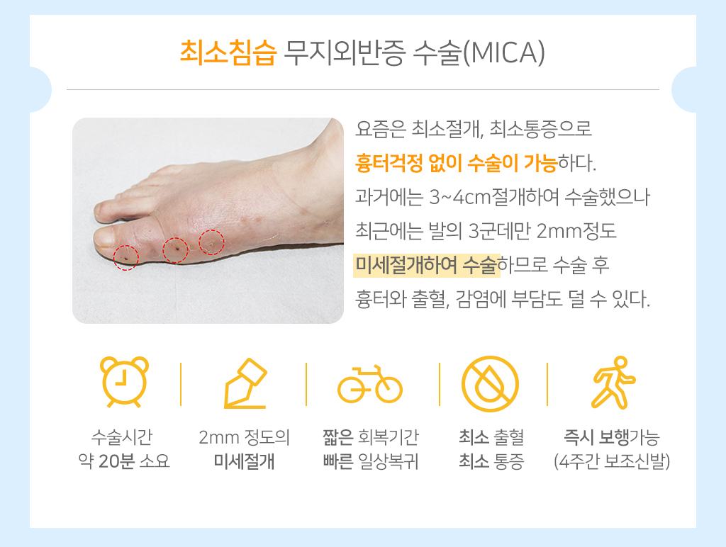최소침습 무지외반증 수술(MICA) 요즘은 최소절개, 최소통증으로 흉터걱정 없이 수술이 가능하다. 과거에는 3~4cm절개하여 수술했으나 최근에는 발의 3군데만 2mm정도 미세절개하여 수술하므로 수술 후 흉터와 출혈, 감염에 부담도 덜 수 있다. 수술시간 약 20분 소요, 2mm 정도의 미세절개, 짧은 회복기간 빠른 일상복귀, 최소 출혈 최소 통증, 즉시 보행가능 (4주간 보조신발)