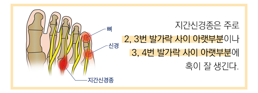  지간신경종은 주로 2,3번 발가락 사이 아랫부분이나 3,4번 발가락 사이 아랫부분에 혹이 잘 생긴다. 