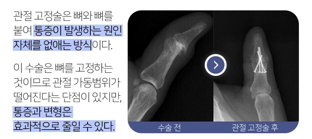 관절 고정술은 뼈와 뼈를 붙여 통증이 발생하는 원인 자체를 없애는 방식이다. 이 수술은 뼈를 고정하는 것이므로 관절 가동범위가 떨어진다는 단점이 있지만, 통증과 변형은 효과적으로 줄일 수 있다. 