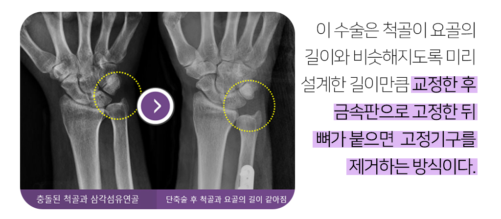 이 수술은 척골이 요골의 길이와 비슷해지도록 미리 설계한 길이만큼 교정한 후 금속판으로 고정한 뒤뼈가 붙으면  고정기구를 제거하는 방식이다.
