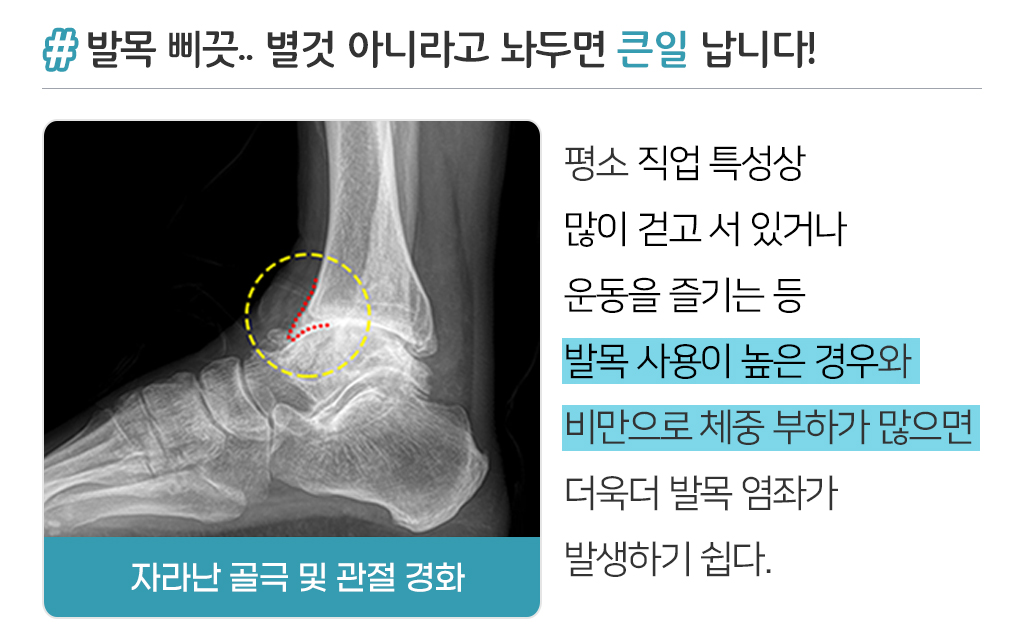 발목 삐끗... 별것 아니라고 놔두면 큰일 납니다!/ 평소 직업 특성상 많이 걷고 서있거나 운동을 즐기는 등 발목 사용이 높은 경우와 비만으로 체중 부하가 많으면 더욱더 발목 염자가 발생하기 쉽다.