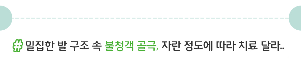 밀집한 발구조 속 불청객 골극, 자란 정도에 따라 치료 달라...
