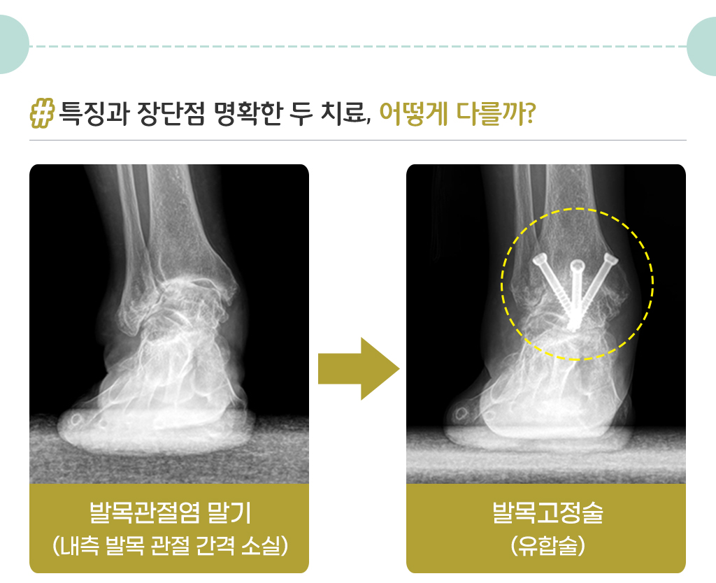 특징과 장단점이 명확한 두 치료 어떻게 다를까?/ 발목관절염 말기에서 발목고정술 사진/ 발목관절염 말기에서 발목인공관절 사진