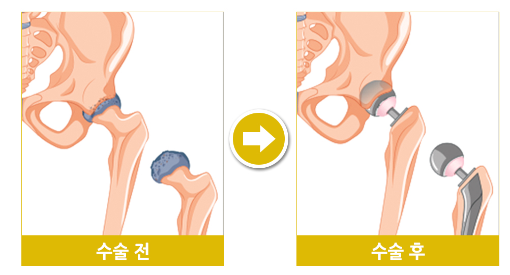 고관절 인공관절 시술사진