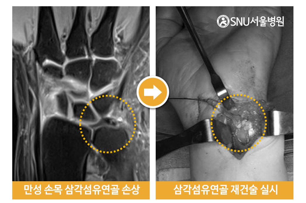 만성 손목 삼각섬유연골 손상, 삼각섬유연골 재건술 실시