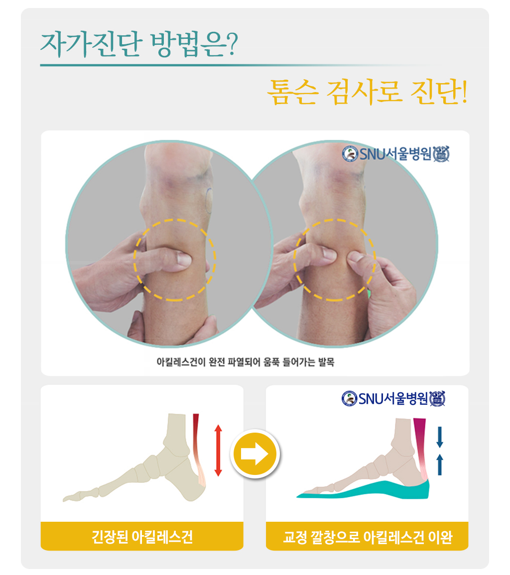 자가진단 방법은? 톰슨 검사로 진단!