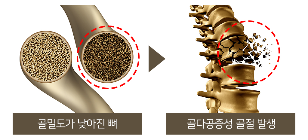 골밀도가 낮아진 뼈 -> 골다공증성 골절 발생