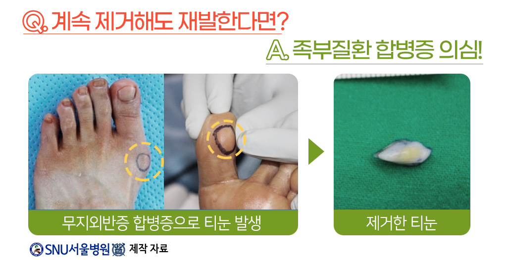 계속 제거해도 재발한다면? 족부질환 합병증 의심!