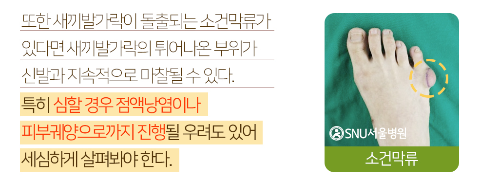 또한 새끼발가락이 돌출되는 소건막류가 있다면 새끼발가락의 튀어나온 부위가 신발과 지속적으로 마찰될 수 있다. 특히 심할 경우 점액낭염이나 피부궤양으로까지 진행될 우려도 있어 세심하게 살펴봐야 한다.