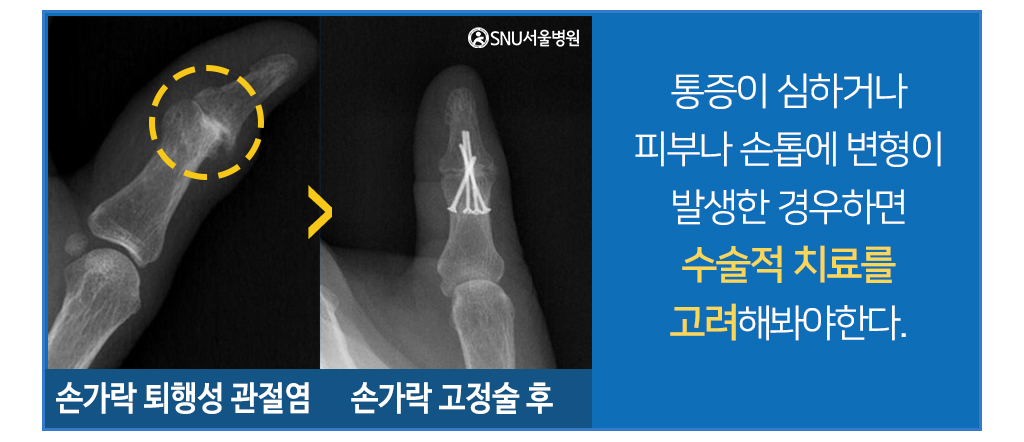 손가락 고정술 사진/ 통증이 심하거나 피부나 손톱에 변형이 발생한 경우라면 수술적 치료를 고려해봐야한다.